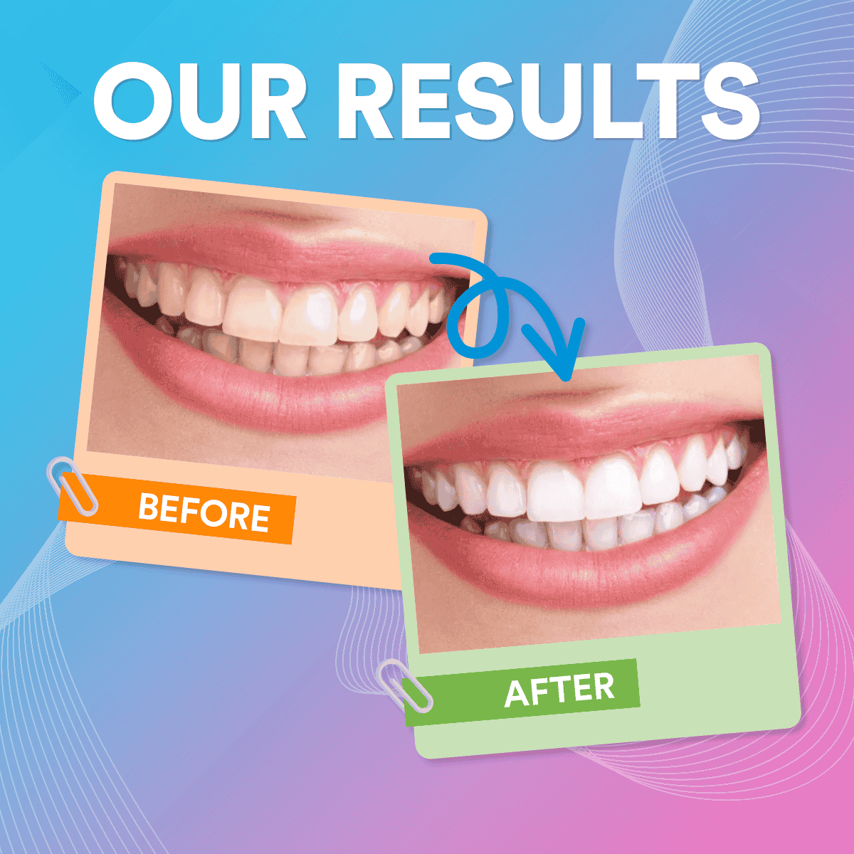 V34 Colour Corrector tooth whitening Serum