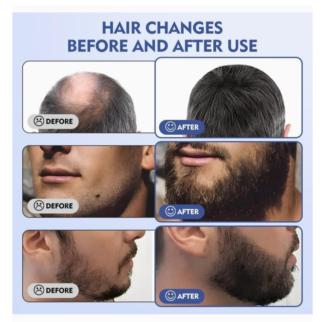 140 Adjustable Microneedle (0.25mm) for Enhanced Skincare – Professional Derma Roller"